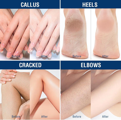40% Urea Hand Foot Cream Intensive Moisturiser for Dry Cracked Skin | Intensive Moisturising Care for Dry Cracked Heels, Hands and Calloused Skin; 350G